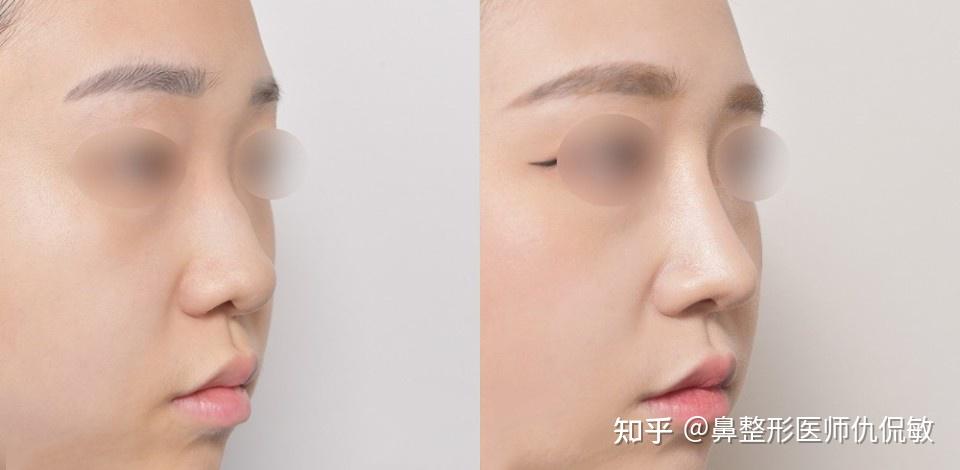 鞍鼻可以分为哪几种?矫正方法又有哪些? - 知乎