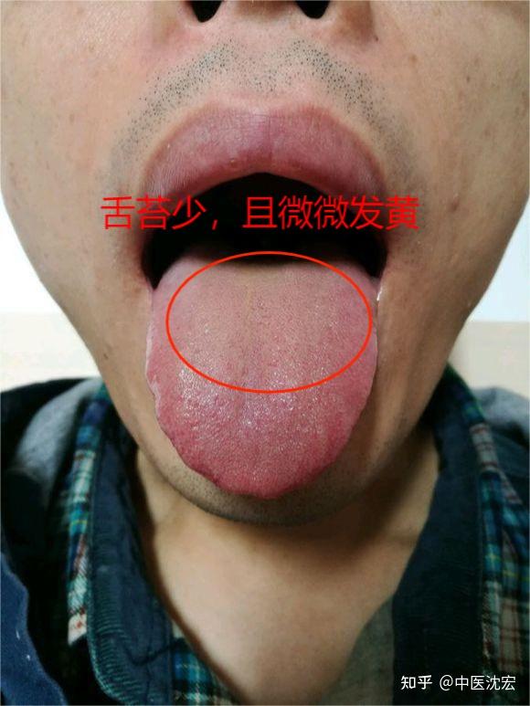 肾虚的人,常见这4种舌苔,看你属于哪一种? - 知乎