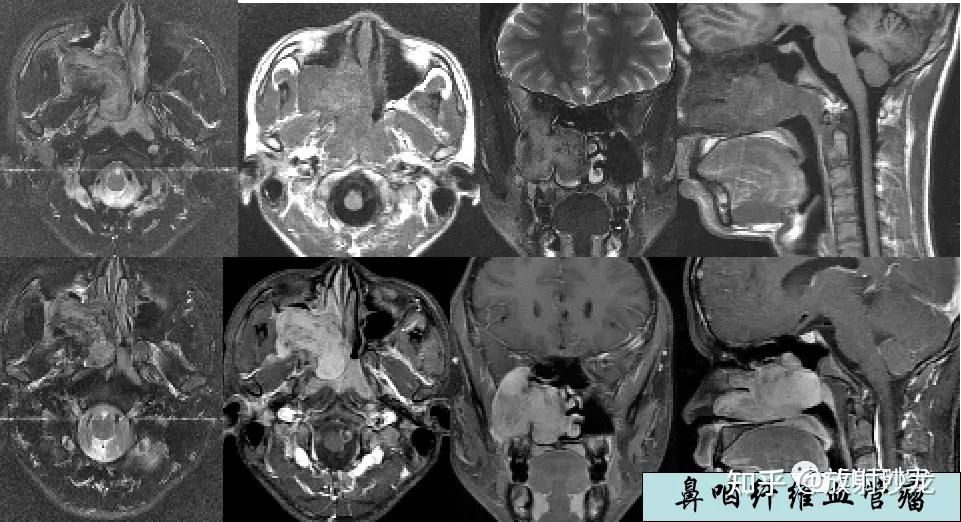 6种鼻咽部疾病的影像诊断与鉴别 - 知乎