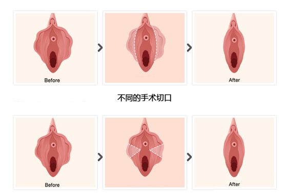 私密整形 关于小阴唇整形 你必须要知道的问题 知乎