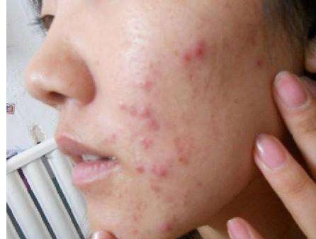 粉刺露使用方法要护肤吗 v2-3975fc0983c47ebb527f3ef9d61ee5da_r.jpg