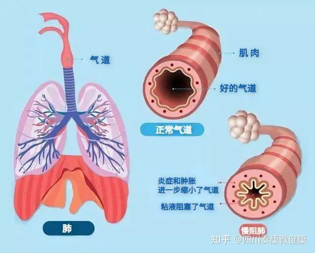 肺同小可带您了解慢性阻塞性肺疾病