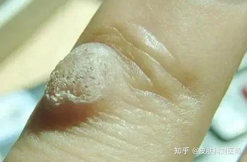什么是疣?疣的分类及治疗!你想知道的都在这儿 - 知乎