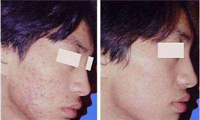 工程师陈先生祛痘经历(康痘士)