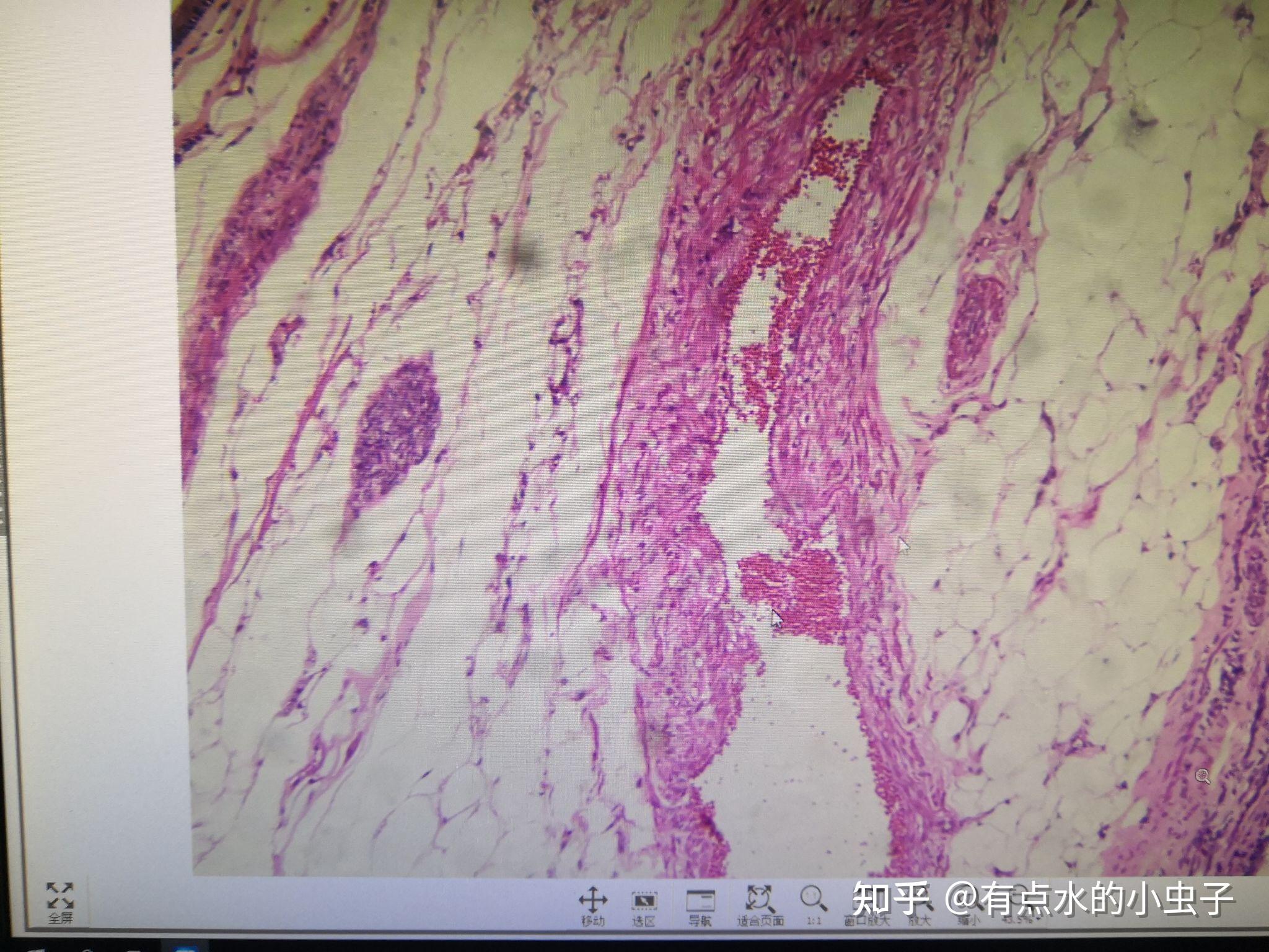 肾脓肿流行性脑脊髓膜炎朗汉斯巨细胞结核性肉芽肿纤维瘤(背景)纤维