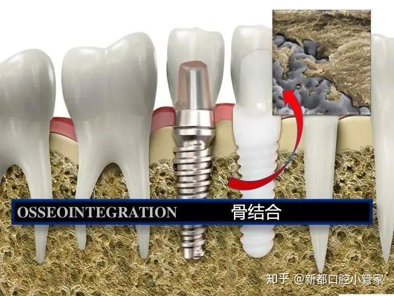 了人们对种植牙的错误认识,让牙齿松动和经常担心牙槽骨不够好的患者