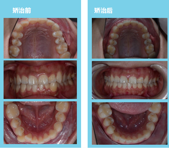 隐形牙套真的可以矫正牙齿吗