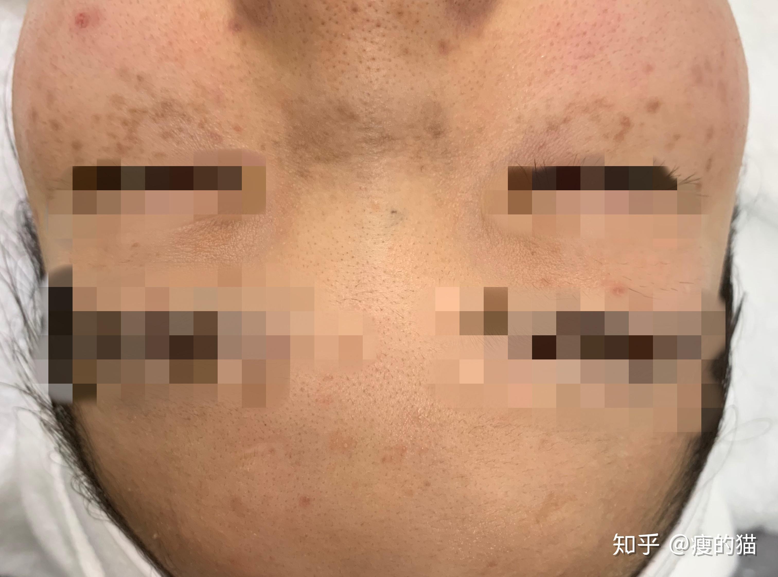 后天性的太田斑多长于青壮年女性,分布在额头,太阳穴,两侧颧骨,眼下面