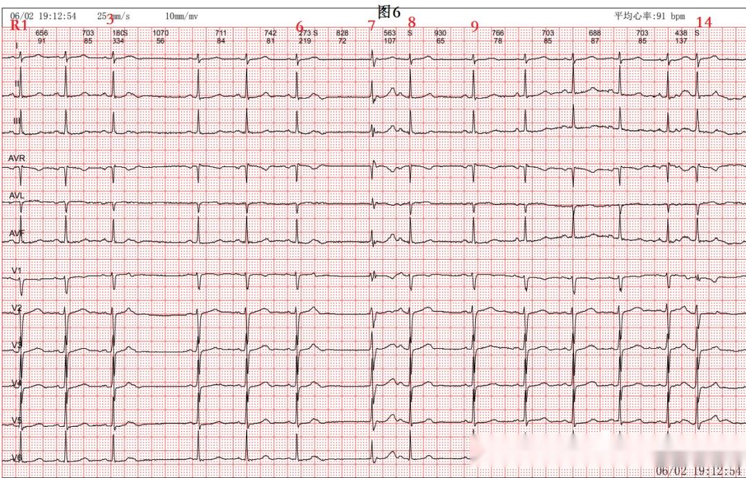 图5心电图分析:r4,r7-r10后有提前出现的有p(在t波中),其后无qrs波群