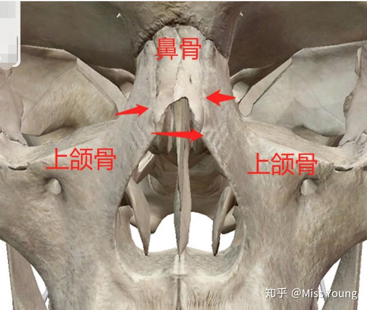 体现在人脸上就是下面这样,鼻骨和上颌骨的链接处形成的宽度过大