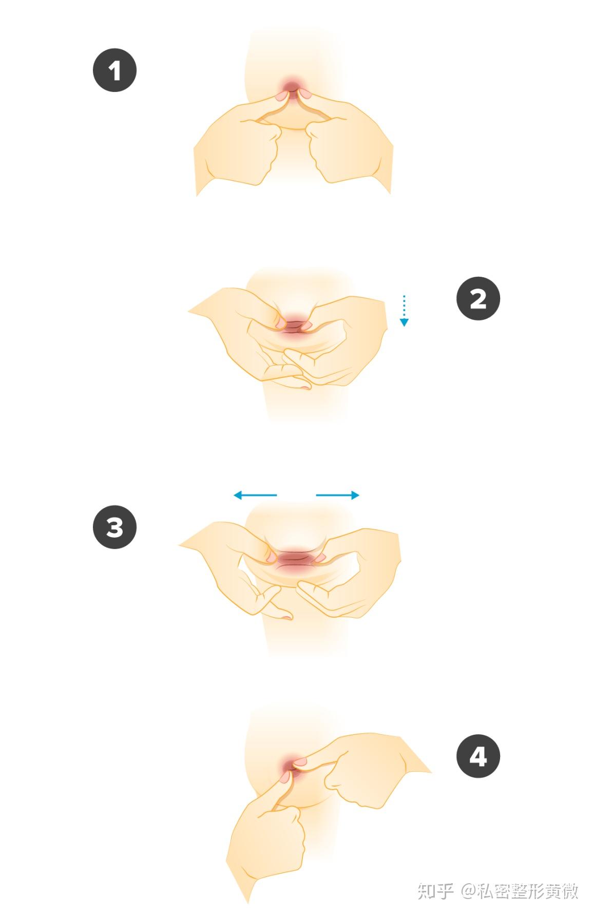 乳头内陷需要治疗吗
