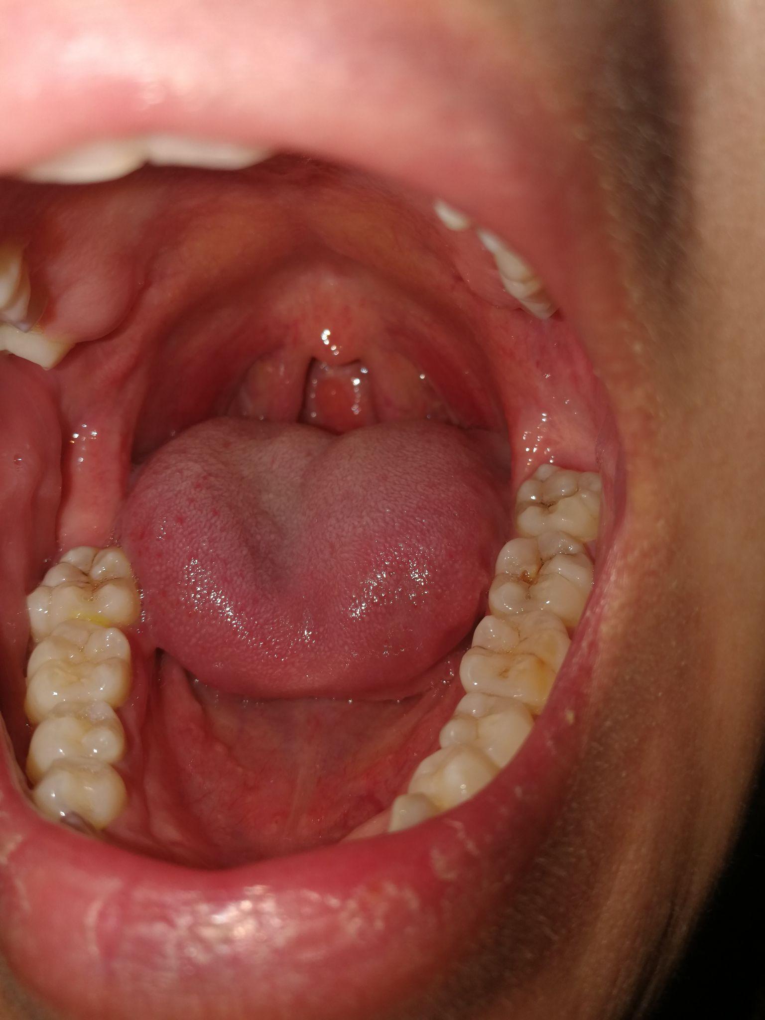 扁桃体结石是如何形成的