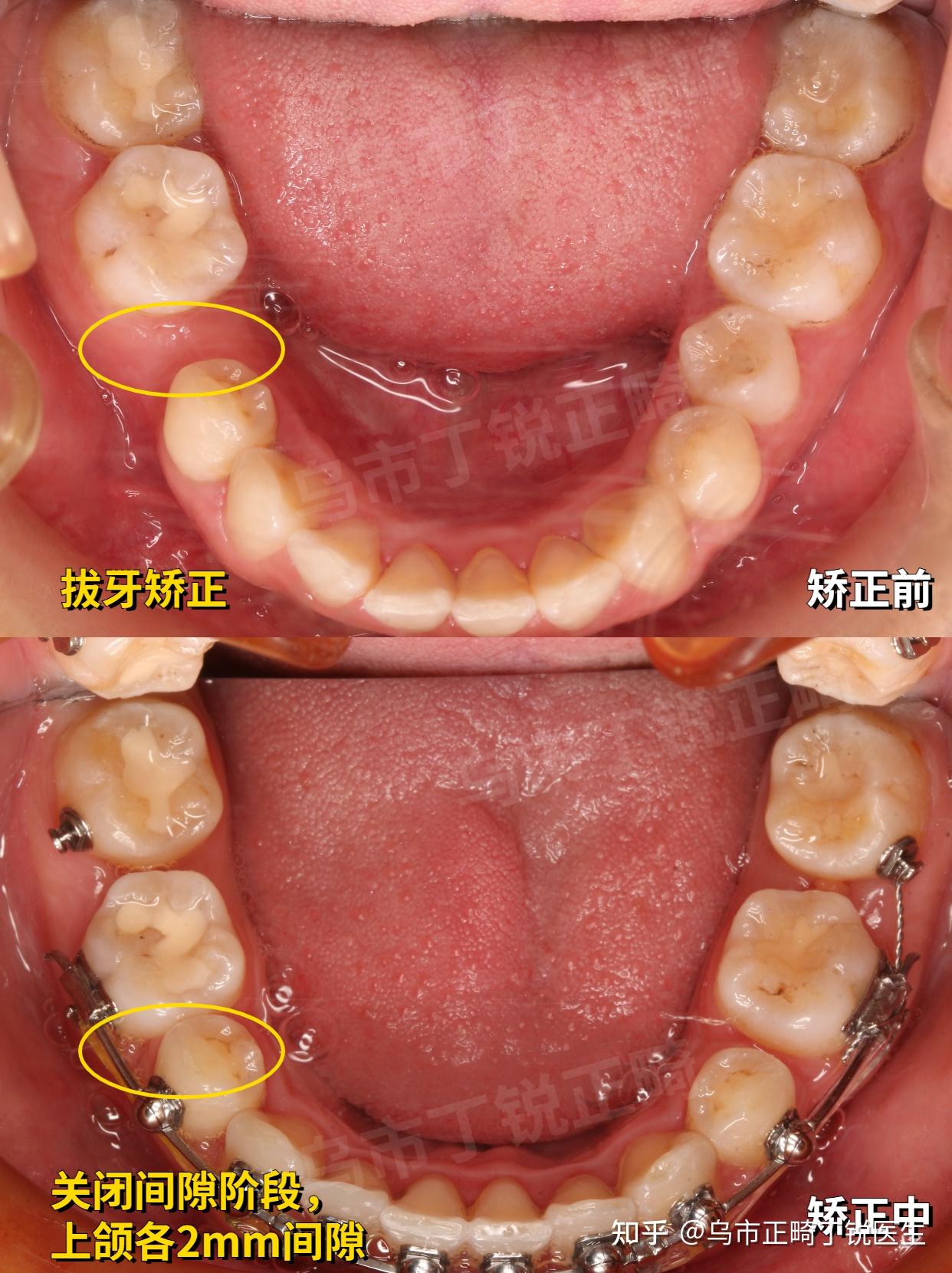 牙齿不齐的发病因素一般为遗传性因素和获得性因素两大类 | 南宁牙齿矫正-南宁众雅口腔