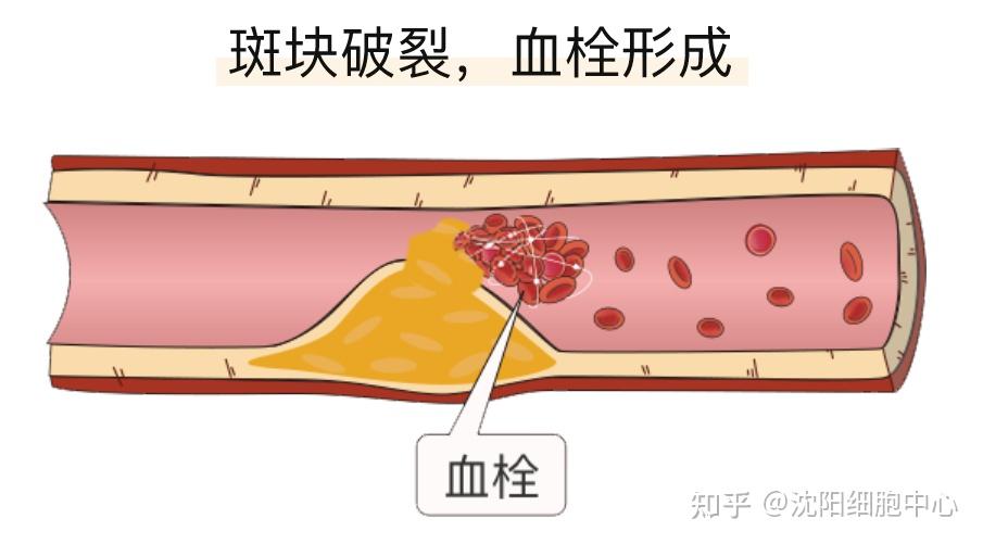 “阳”后3-6个月内要特别小心，有人差点截肢！ - 知乎