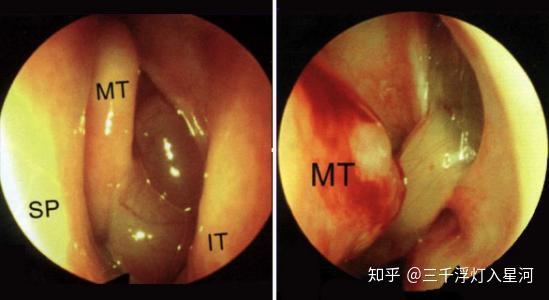 鼻息肉和鼻肿瘤的症状有什么区别 知乎