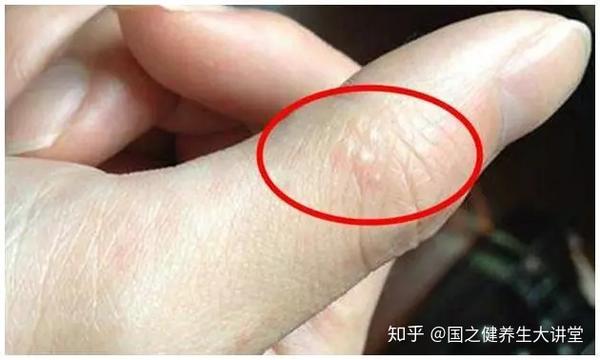 手上长这种透明小水泡 那是身体向你发出的求救信号 知乎 手上长这种透明小水泡 那是身体向你发出的求救信号 知乎