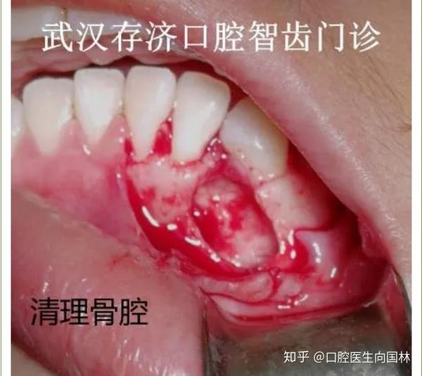 案例15岁女孩做牙齿矫正竟然检查出大问题