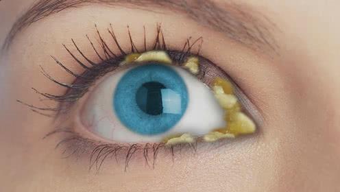 确认过眼屎你遇上了眼疾这4类眼屎不可小觑