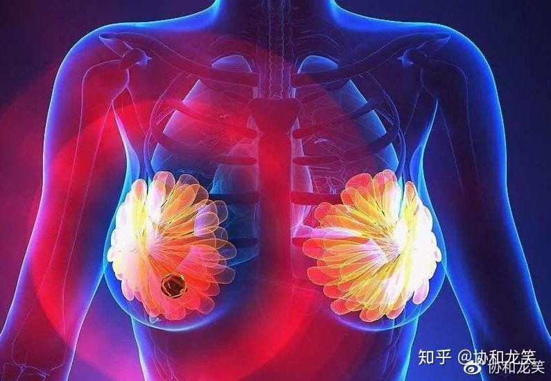 乳腺癌術後常見併發症淋巴水腫bcrl