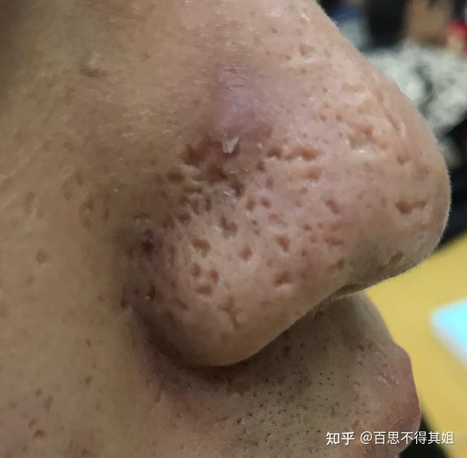 黑頭擠完留的大洞如何處理