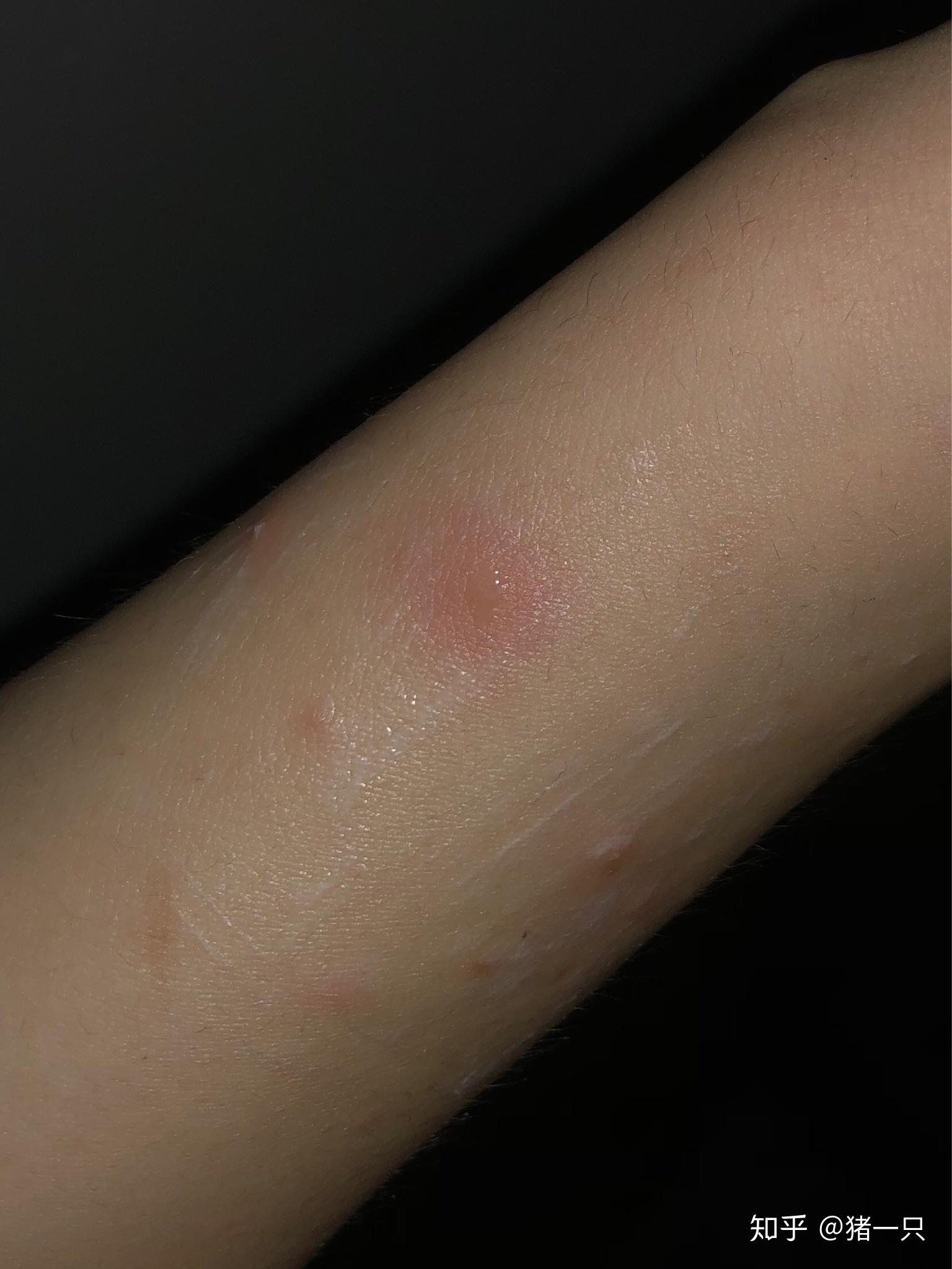 这是被什么虫子咬了? - 知乎