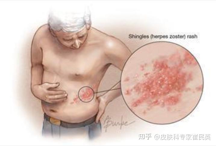 皮肤有疙瘩身上起疹子注意这些情况需要警惕