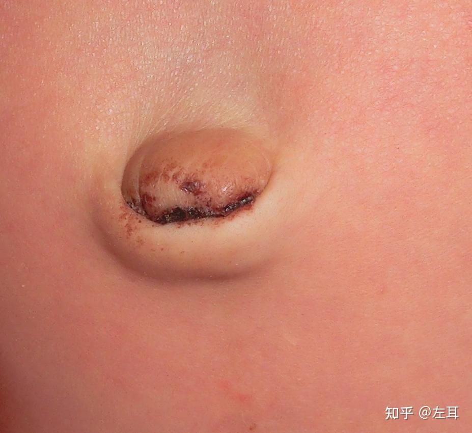 其次要注意宝宝的肚脐,新生儿肚脐粘到水或尿液很容易发炎,要求平常要