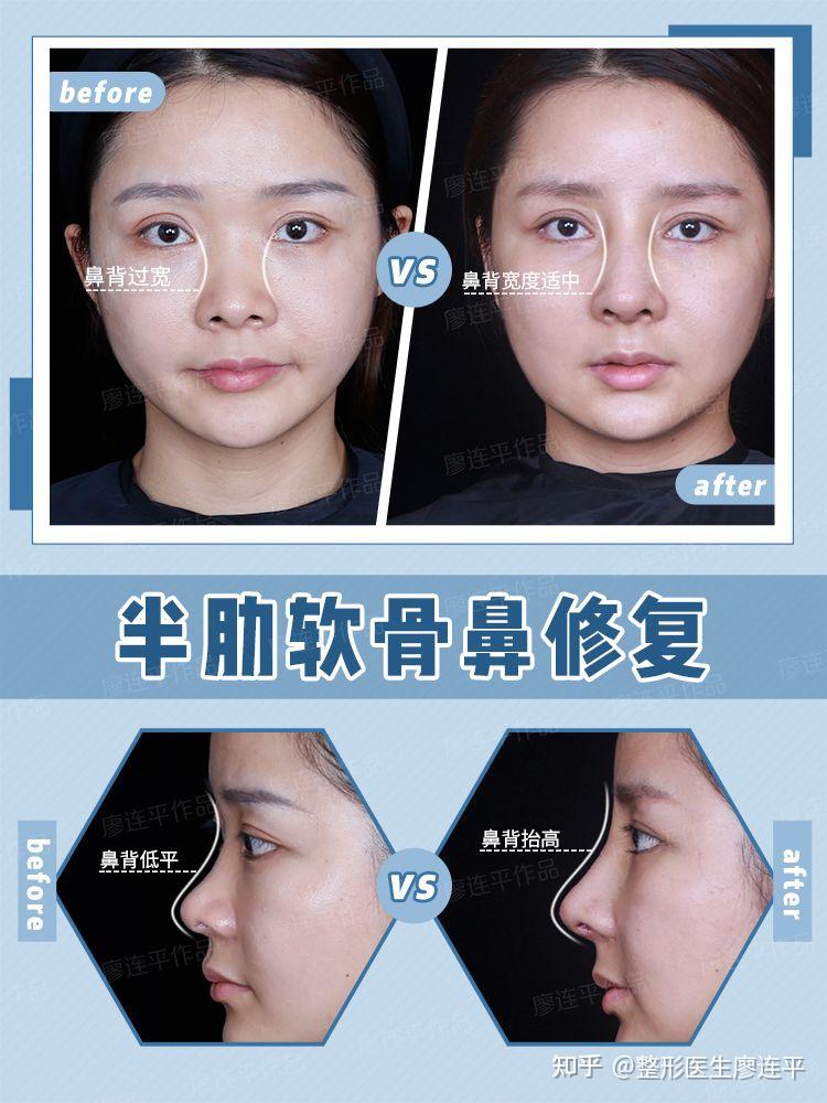 鼻子审美(十一)-鼻背的美学 - 知乎