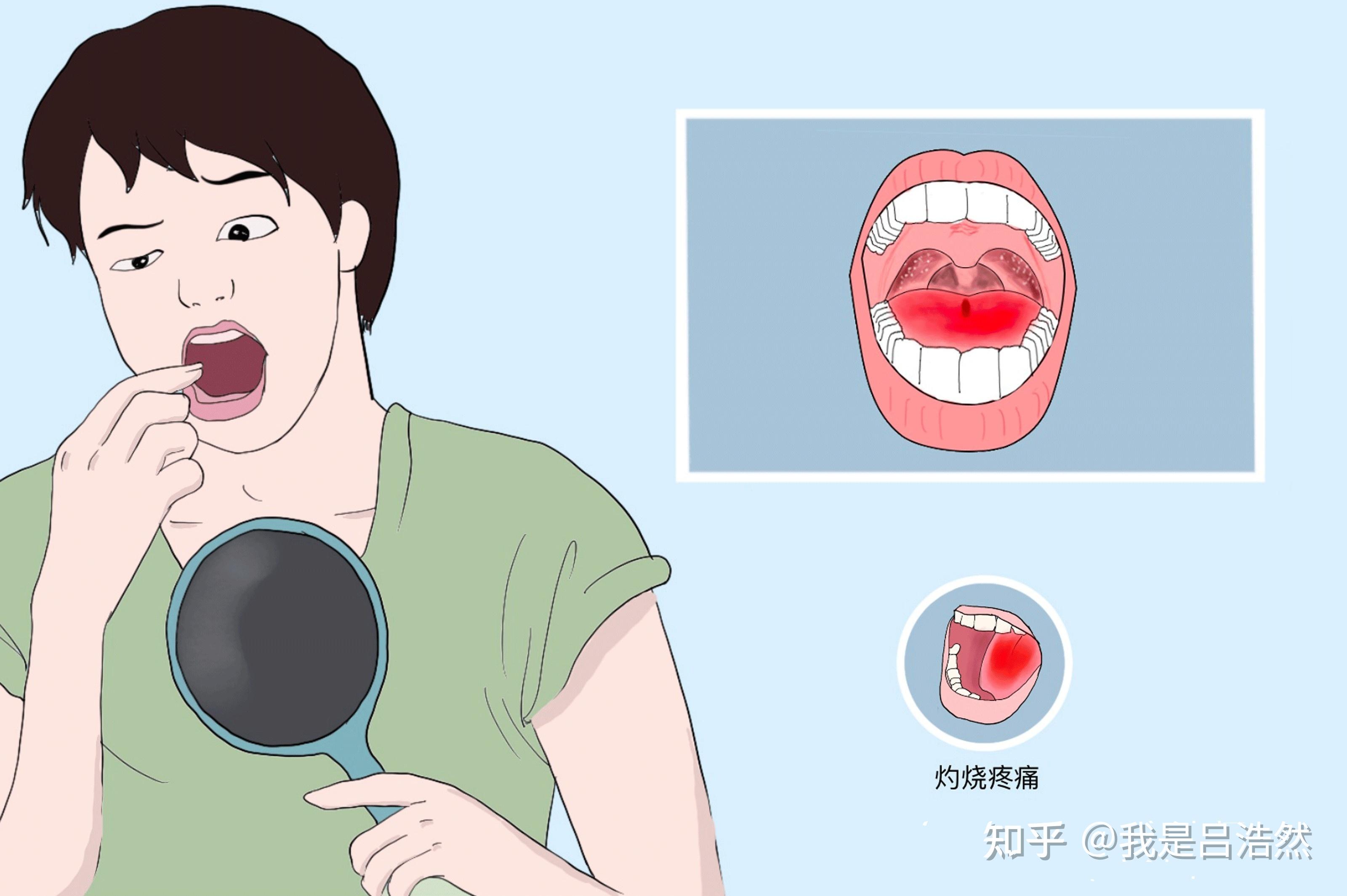 舌头烧灼样疼痛是怎么了？灼口综合征的诊断要点你真的了解吗？__凤凰网