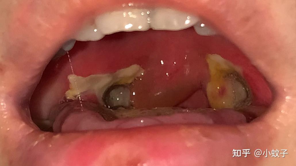 一个大朋友的扁桃体切除手术过程记录