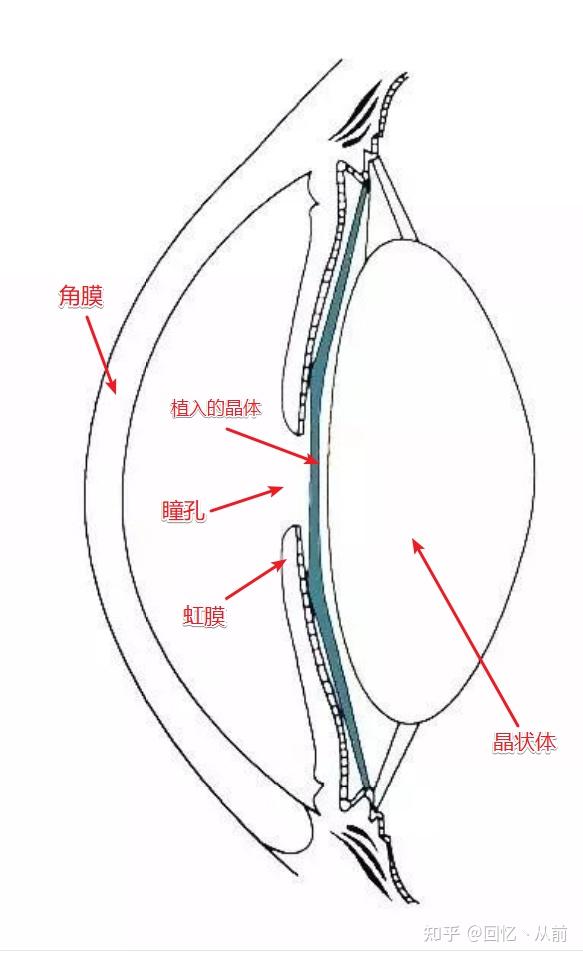 Icl缺点分析 重影 光圈 炫光 知乎