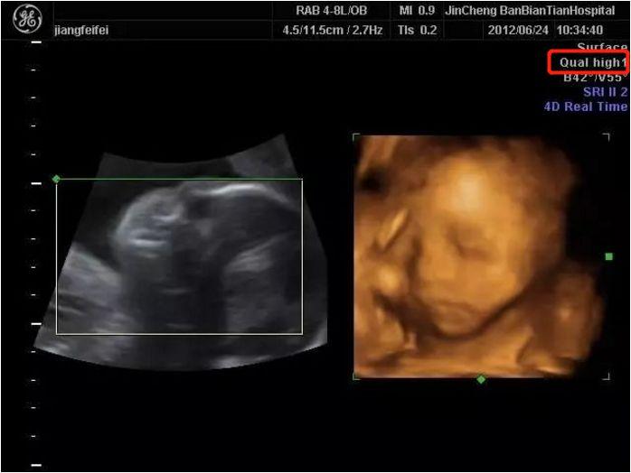 生男生女 四维彩超最全解读 新手孕妈必看 知乎