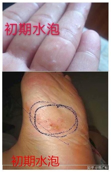 五种脚气 - 知乎