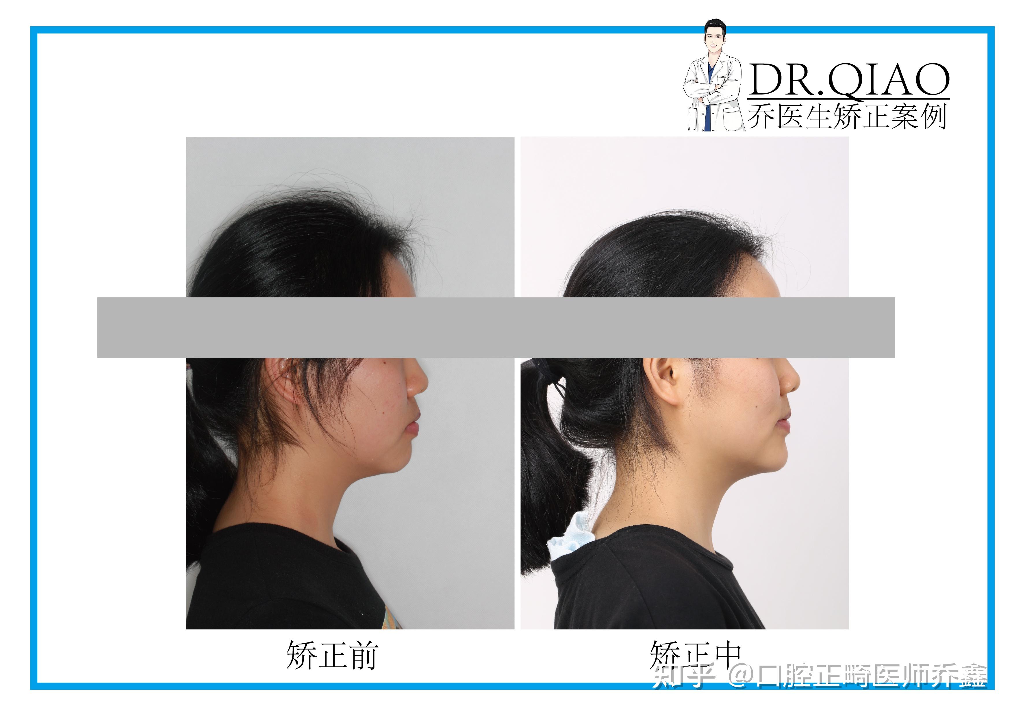 矫正牙齿前自己要做什么功课? - 知乎
