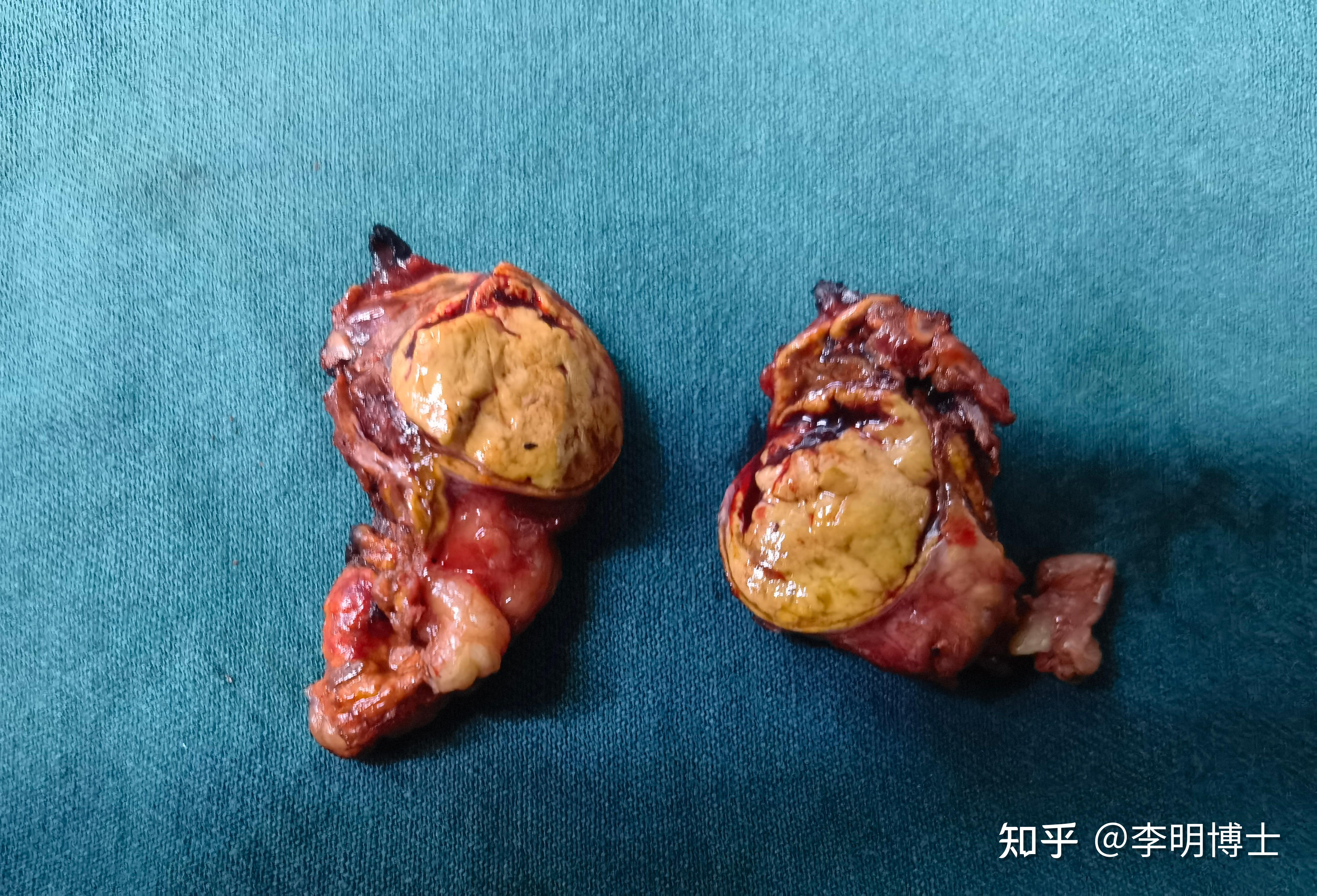 腹腔镜左肾上腺肿瘤切除术