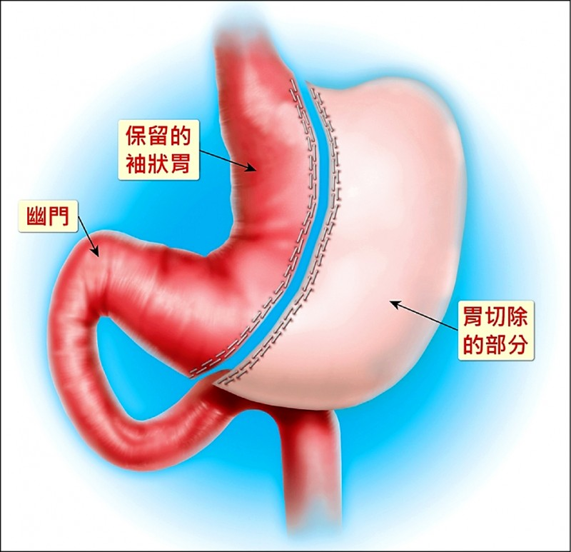 切胃真能瘦下去医生可以但减重手术非人人适合