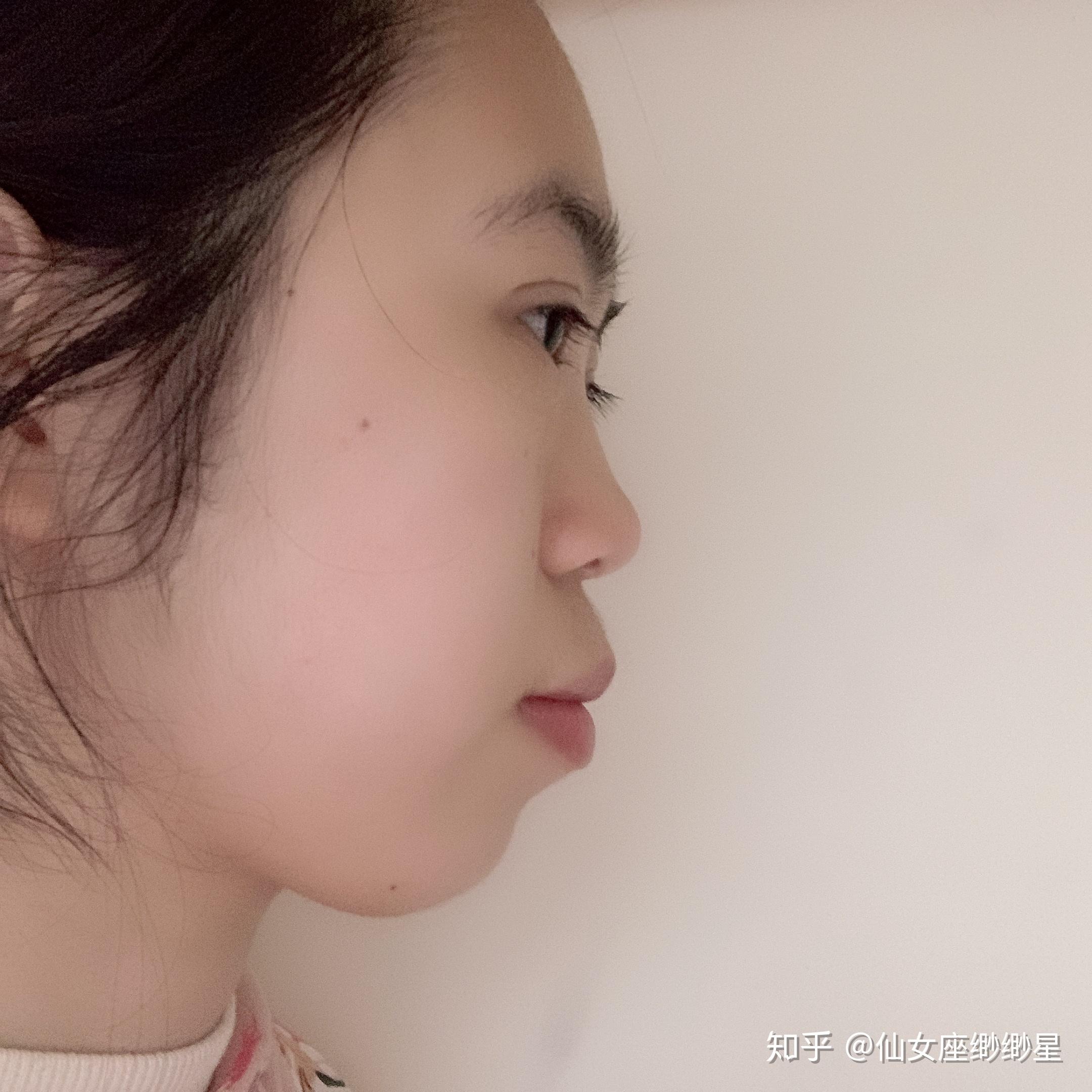 大龄女青年的龅牙矫正史