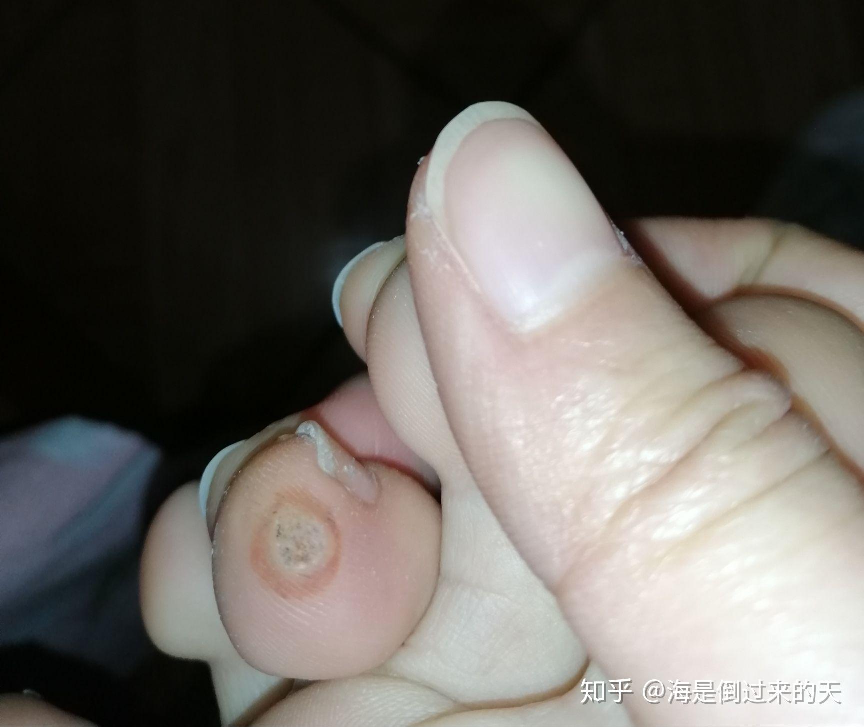 治疗瘊子,疣的无痛过程 - 知乎