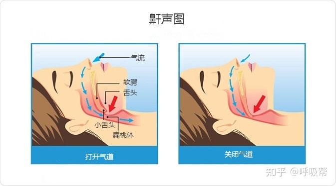 一文教您分辨打鼾的类型和原因 - 知乎