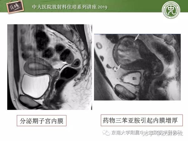 子宫详细解剖及磁共振信号分析 - 知乎