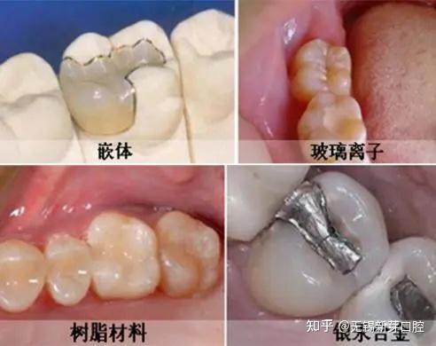 牙齿到了什么程度要补牙?4种需要补牙的情况一篇文章讲清楚 - 知乎