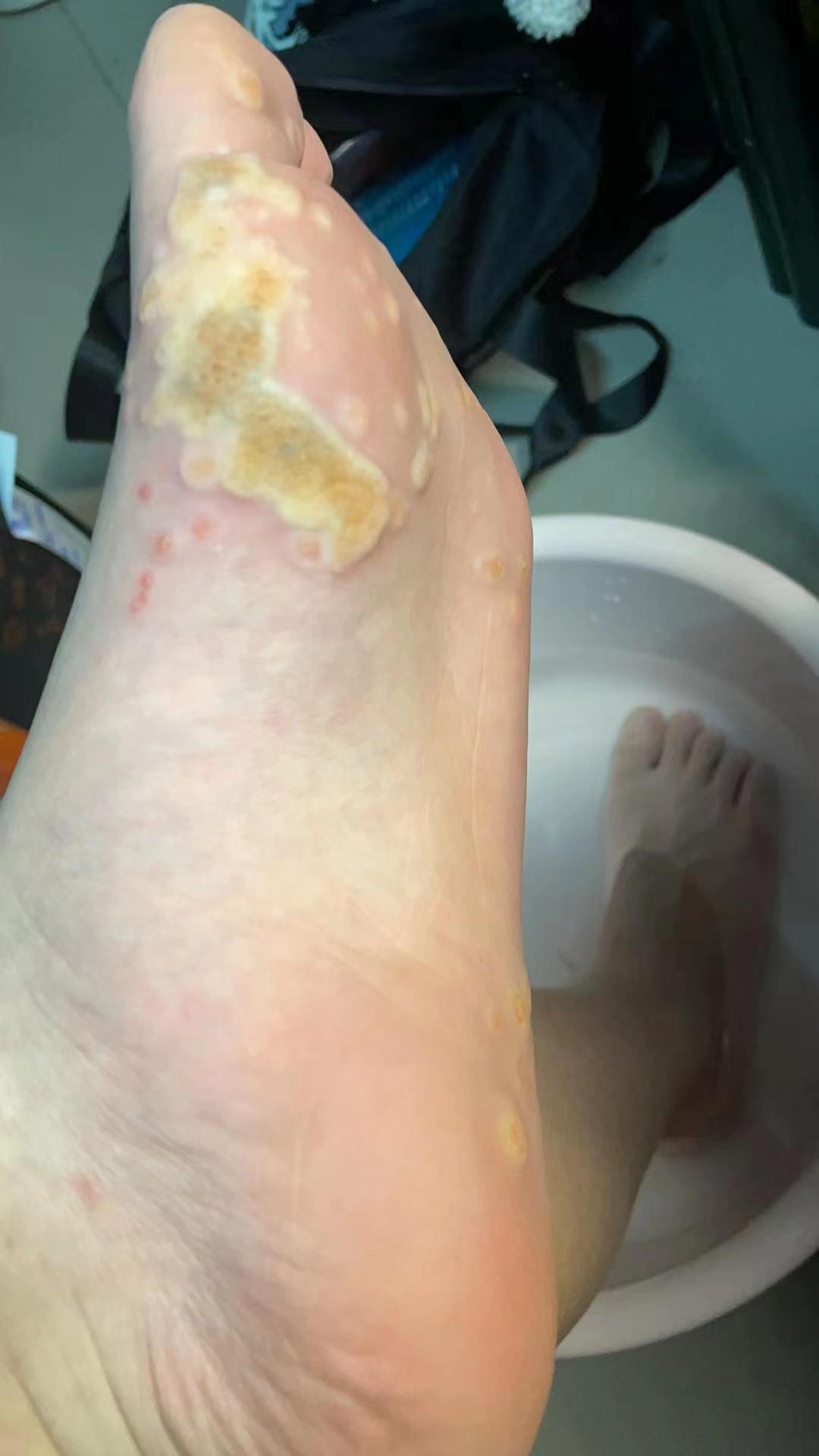 这种就是典型的跖疣案列,泡脚后都是泛白的小坑 - 知乎