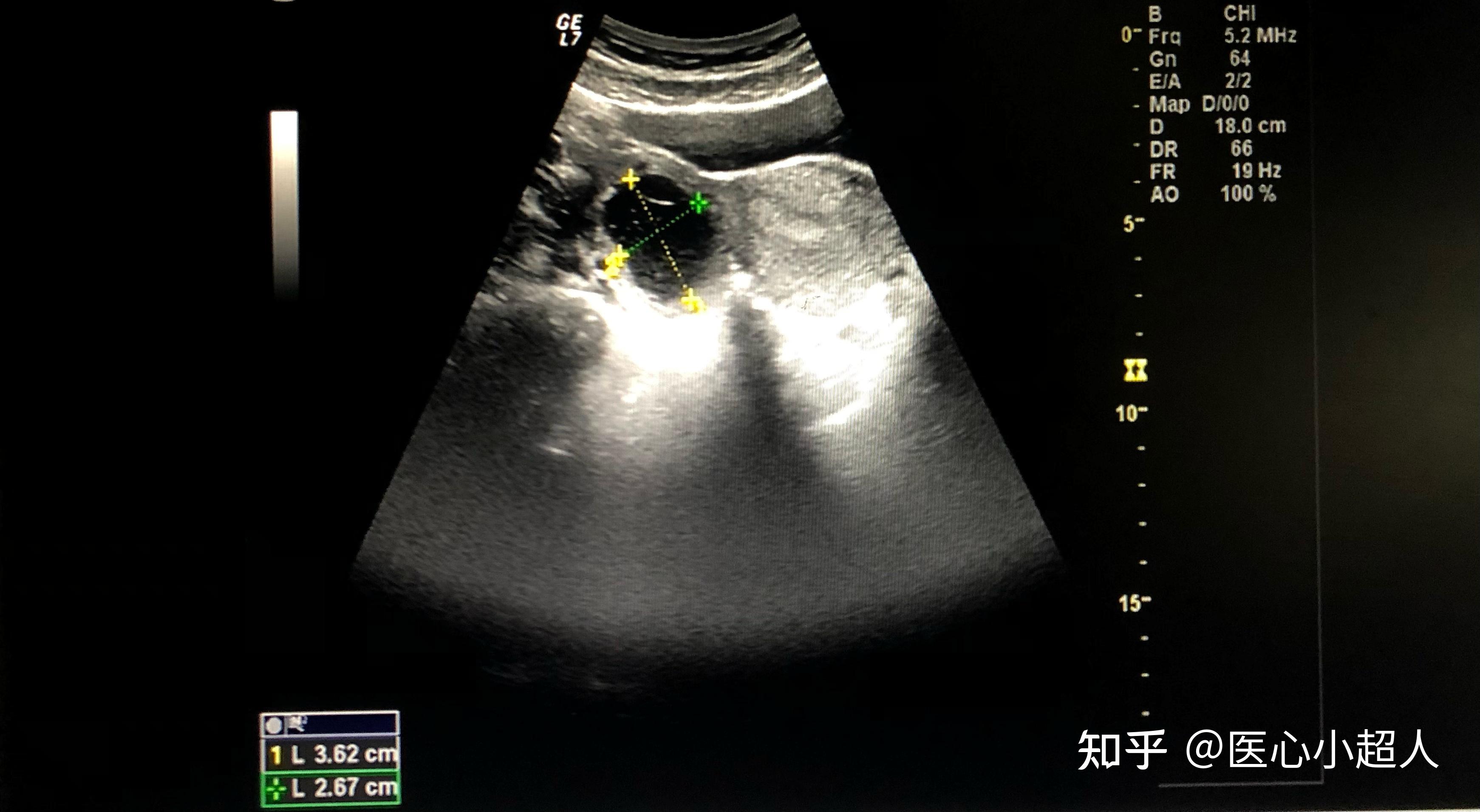 卵巢肿瘤声像图的分类 - 知乎