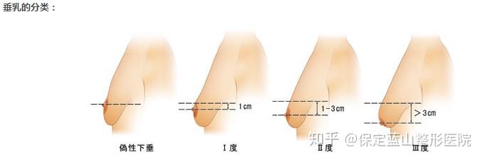 年轻女性,乳头的水平位置一般位于第四第五肋间,若掉在其下即是所谓的