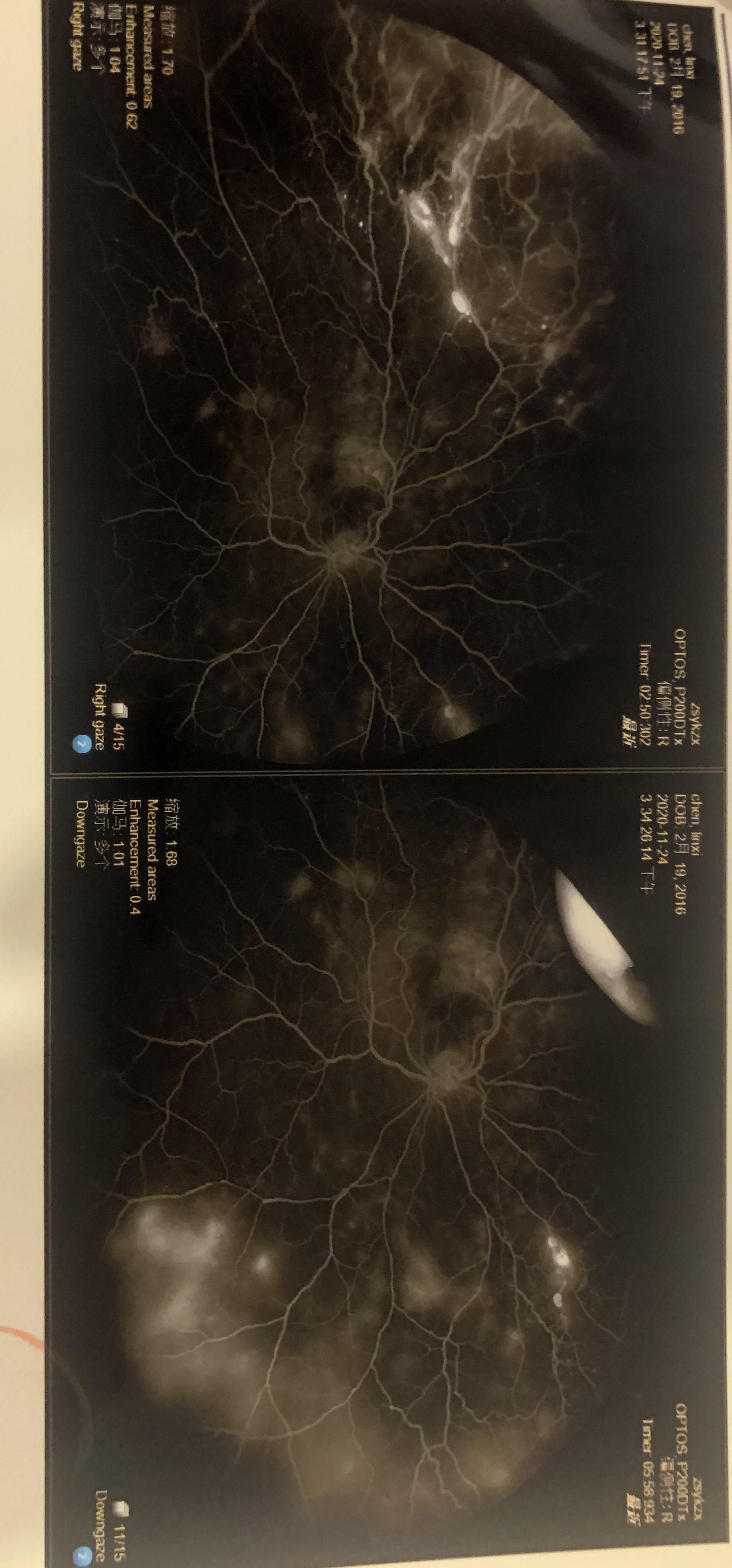 眼底病视网膜病变coats病许多年轻父母明知孩子几乎失明抱着绝望在