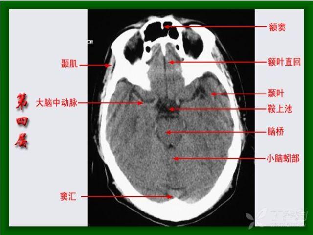 丘脑断层图片