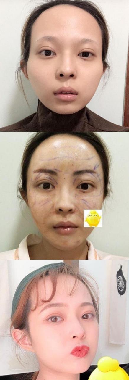 脂肪填充后为什么凹凸不平?如何解决?杭州脂肪填充修复医生哪些好?