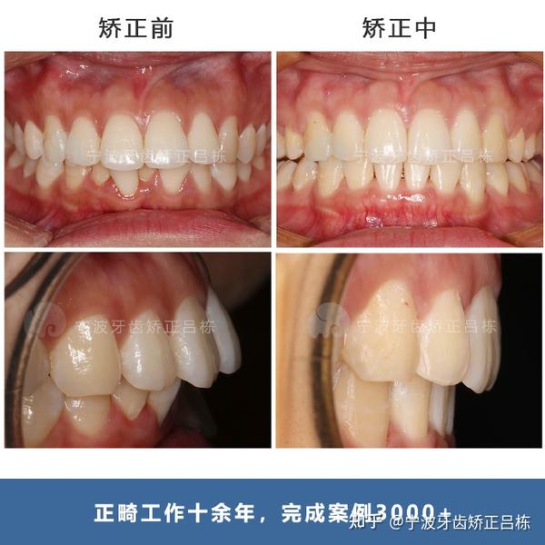 売上最激安 SAM 咬合器 2 www.exceltur.org