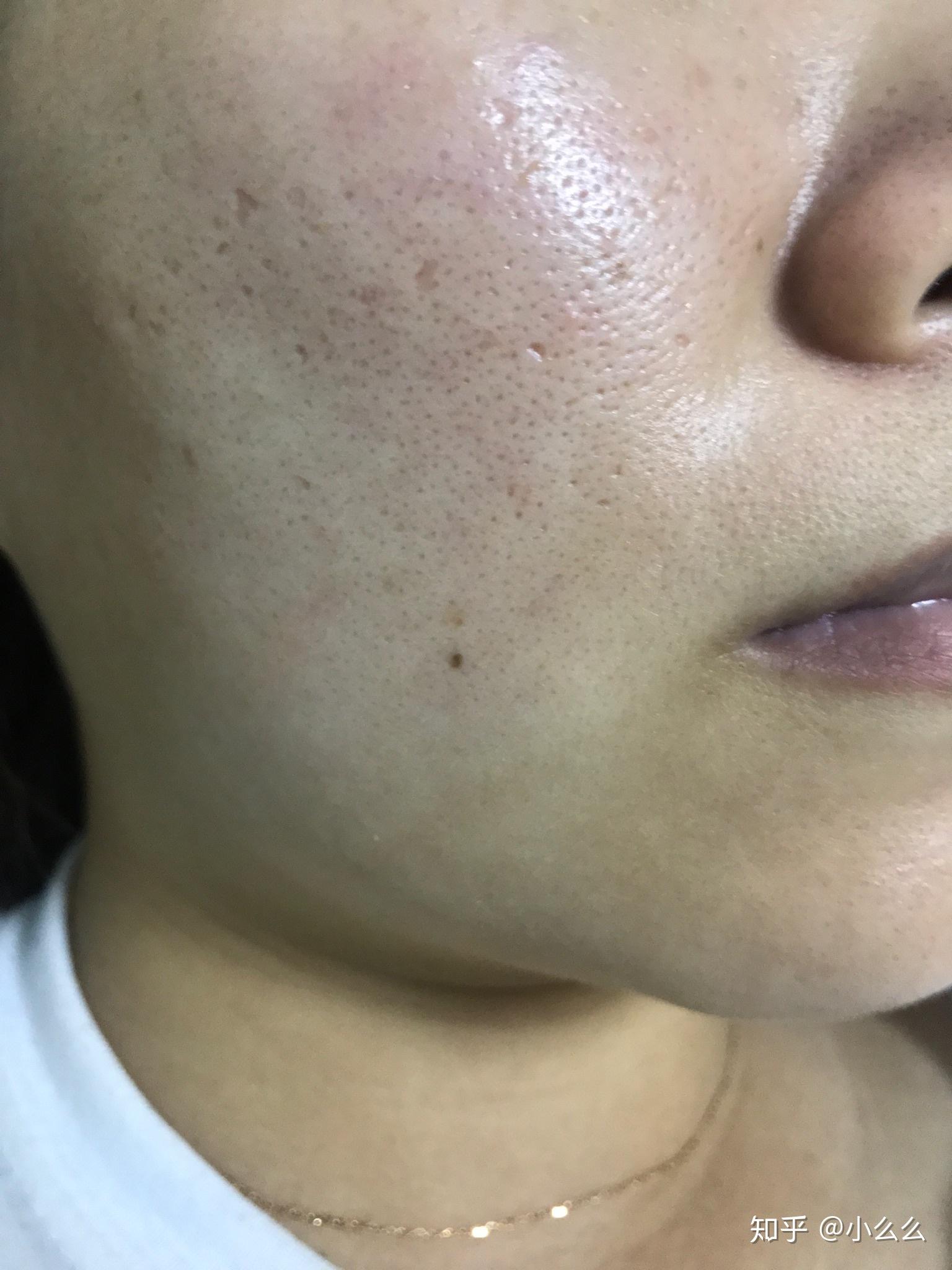 本人痘坑毛孔粗到可以插秧!点阵激光祛痘坑两次对比.(持续更新)