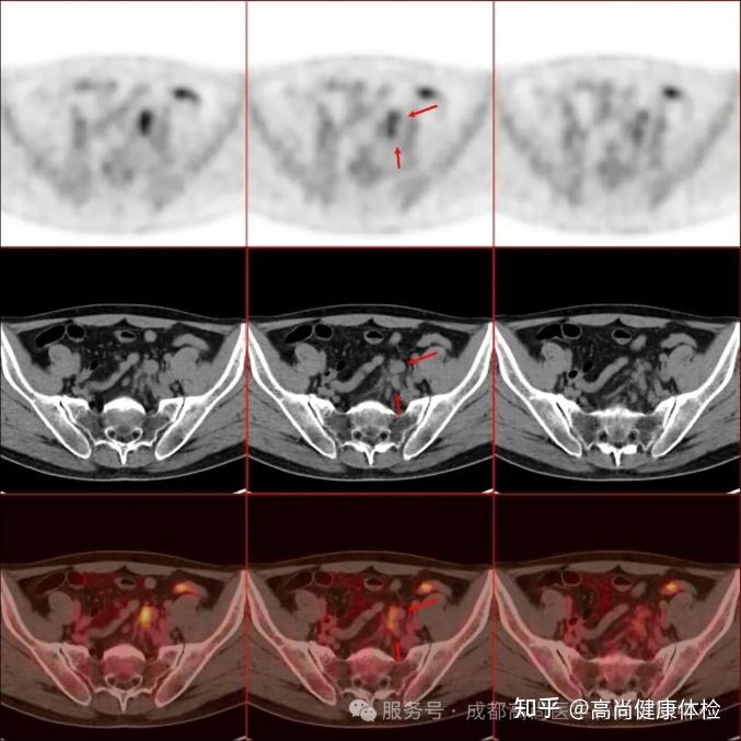 47岁男大便不成形发现直肠腺癌,18F-FDG PET/CT联合HR-MR评估全身情况 - 知乎